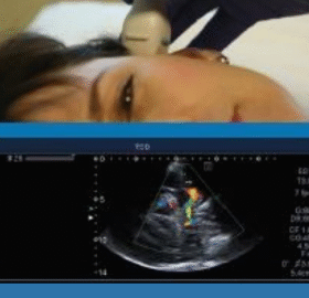 Transcranial Doppler for Cerebrovascular Disease